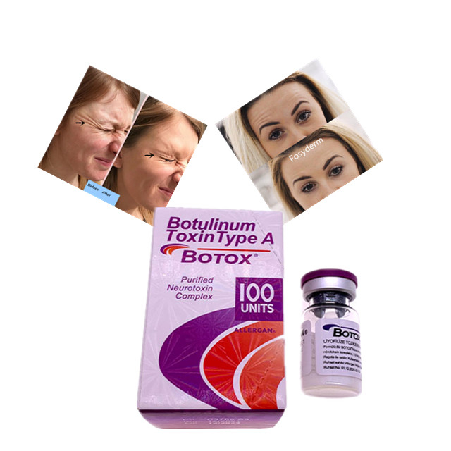 Botulinumgiftstoff-Art Allergan eine Einheits-Hautfüller-Hyaluronsäure  100