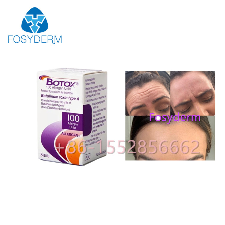 Allergan  100 Einheits-Botulinumgiftstoff-Antifalten schreiben eine Einspritzung
