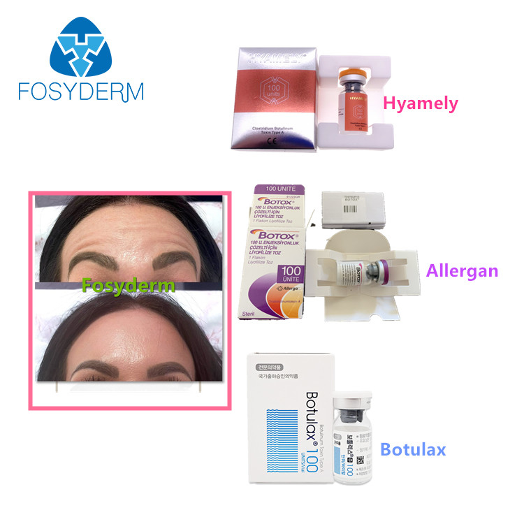 100 Einheiten schreiben einen Botulinumgiftstoff Allergan, das Antigesichtsbehandlung Einspritzung  Botulax knittert