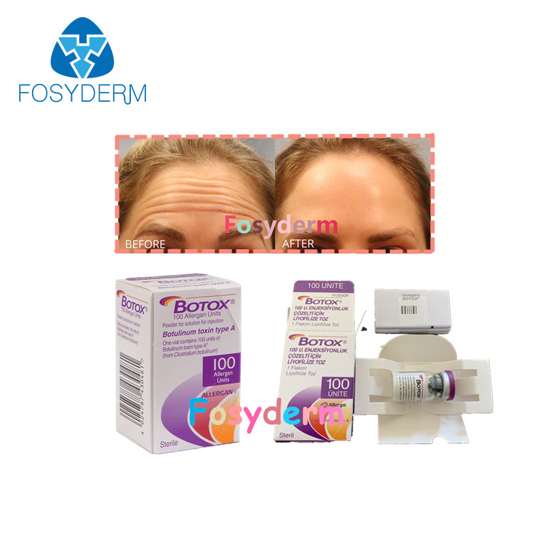 Botulinumantigiftstoff Allergan-Einspritzung TypeA  der falten-100Units