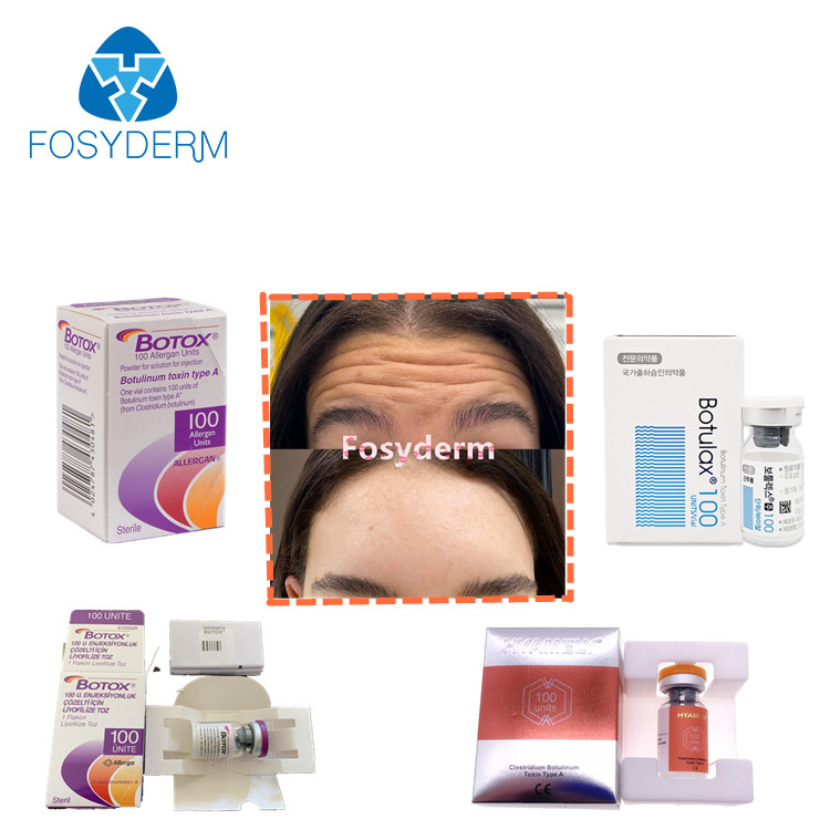 Botulinumgiftstoff-Einspritzungs-Antifalten  Allergan 100units TypeA