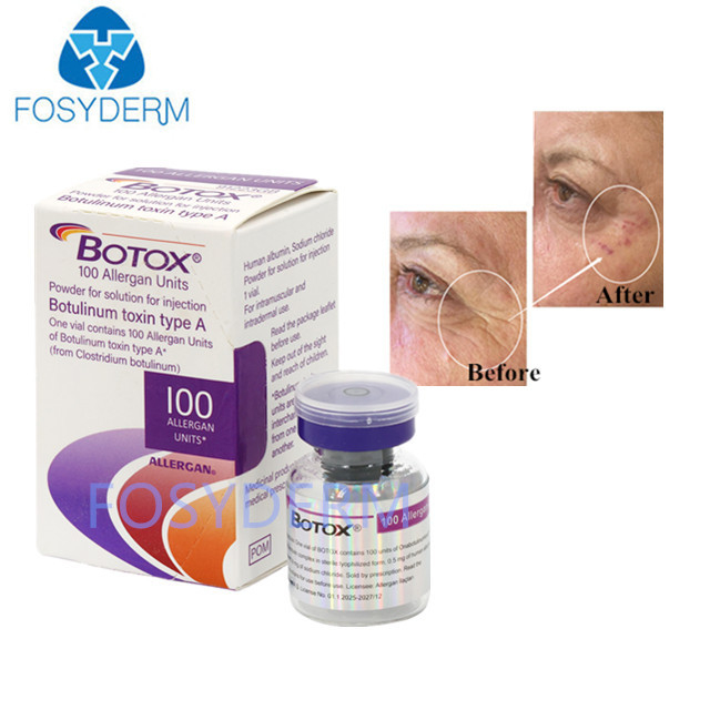 Typ A 100 Einheiten Allergan Botulinum Toxin Hautfüllmittel Hyaluronsäure