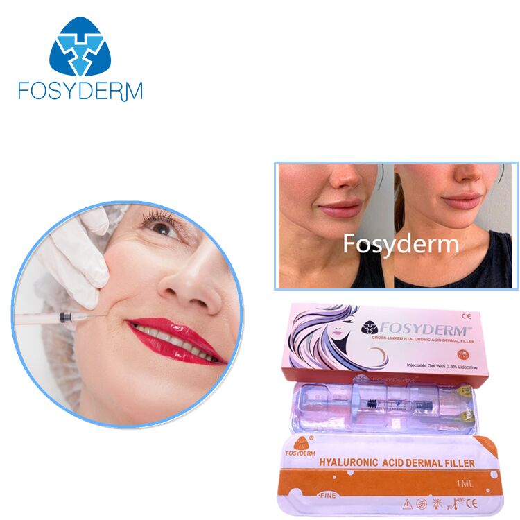 2ml Lippenfüller-Injektion Hyaluronsäure-Dermal-Filler injizierbar für Lippenvergrößerung Gel