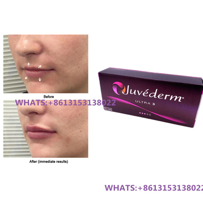 Juvederm Hautfiller für Lippen Juvederm Ultra3 Ultra4 Füllstoffe Vorgefüllte Spritze