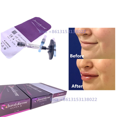 2 × 1 ml Injektionsmittel mit Hautfüllmittel Juvederm Spritze Ultra3 Ultra4 Voluma