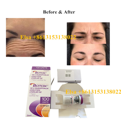 Botulinumgiftstoff-Art Einspritzung Allergan ein Antialtern 100units