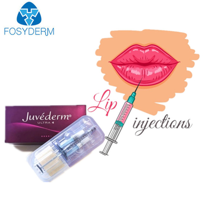 Juvederm ultra 3 Hyaluronsäure-Hautfüller für Gesichts-Lippen