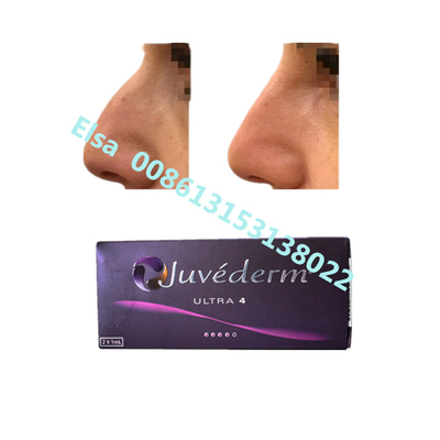 Juvederm Natrium Ultra4 Voluma Hautfüllmittel zur Lippen- und Kinnvergrößerung