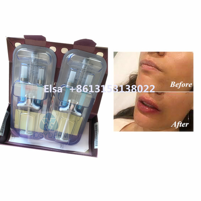 Schönheitsmittel Juvederm Voluma Hyaluronsäure Gesichtsfiller HA Injektion