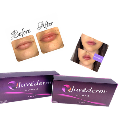 Hyaluronsäure-Hautgel-Einspritzung Juvederm-Lippenfüller-Cer alterndes Anti2ml