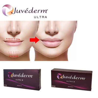 Juvederm Ultra3 Hyaluronsäure-Füllmittel für Lippen