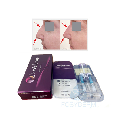 Gesichts-Lippe verband Hauthyaluronsäure-Gel füller Juvederm Ultra3 quer