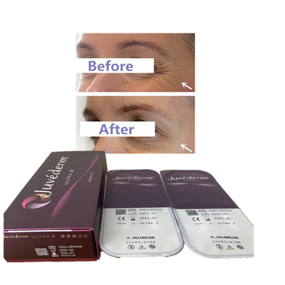 Hyaluronsäure-Hautfüller-Lippenfüller 24mg Juvederm 2ml Ultra3 Ultra4 Voluma