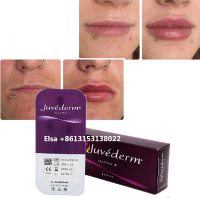 Kosmetik Hautpflege Injektionen Lippenpump Juvederm Füllstoff Injektion für Nase Kinn Lippe