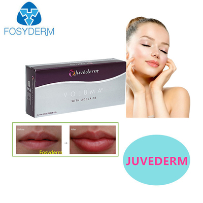Juvederm Hyaluronsäure Hautfüllmittel Sexy Lippen 24mg Für Gesichtsfüllmittel