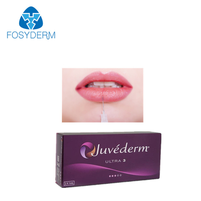 Lippe Juvederm ultra 3 Hyaluronsäure-Hautfüller 2*1ml