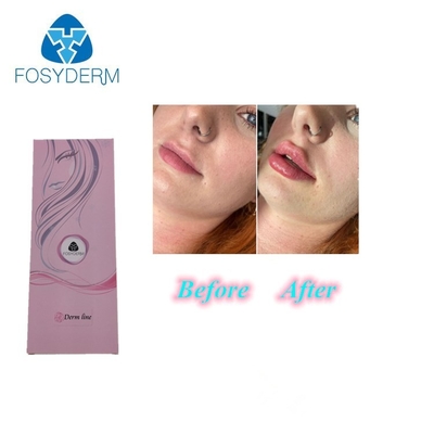 Lippenfüller-Hyaluronsäure-Einspritzung des Lidocaine-1ml 0,3%