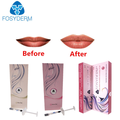 Falten-und Lippenhyaluronsäure-injizierbarer Füller mit Lidocaine