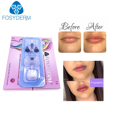 Hyaluronsäure Derm ha CER Bescheinigungs-1ml tiefer Hautfüller für Lippen