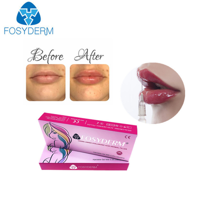 Derm-Lippenverbesserungs-Einspritzung Füller der Hyaluronsäure 1ml Lippenfür Frauen