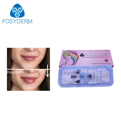 2 ml Füllstoff Hyaluronsäure Hautfüllstoff für Gesicht, Nase und Lippenvergrößerung 24 mg/ml