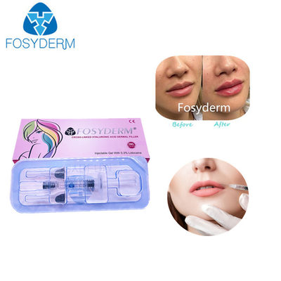 Saures Hyaluronic Kreuz von 2 ml verband Hautfüller-Lippenfüller-Einspritzungen