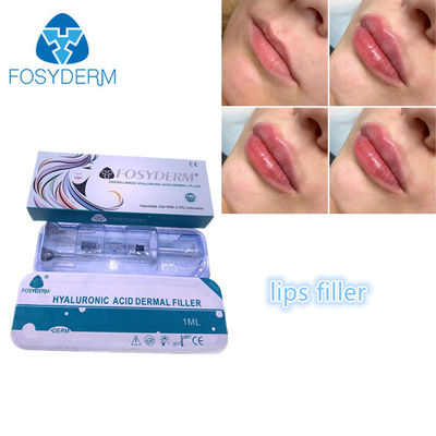 Füllende Hyaluronsäure-Lippenfüller 1ml Gesichts-Einspritzung Fosyderm Fosyderm
