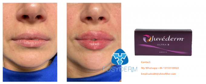 Close-up view of JUVÉDERM injectable gel filler syringe and components